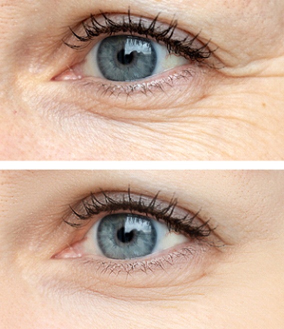 a closeup of around a person’s eyes before and after BOTOX