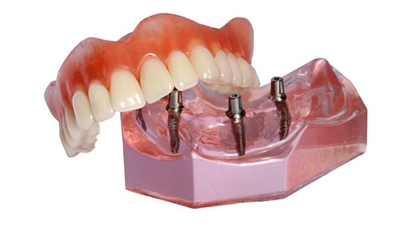 Denture for upper arch resting on jaw model