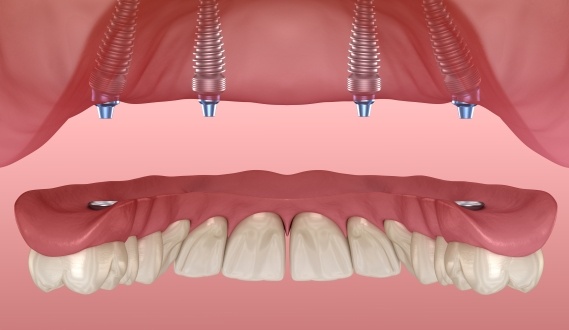 Animated all on four dental implant dentures placement