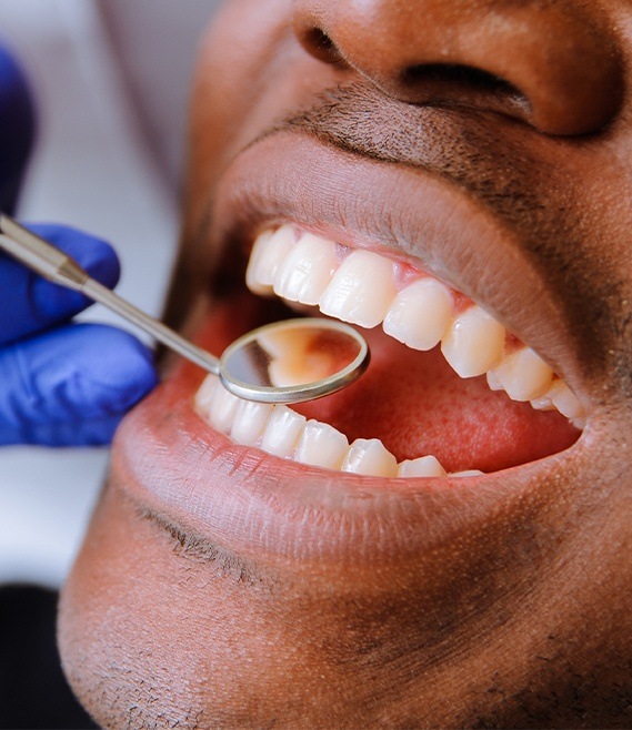 Dentist examining smile after tooth colored filling placement